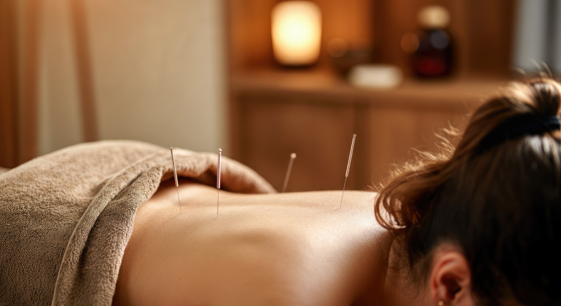 Akupunktur Nadeln auf Meridian-Punkten für therapeutische Behandlung